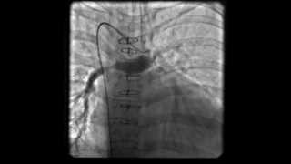 Central Shunt in Pulmonary atresia [upl. by Burack]