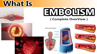 What is Embolism  Clear amp Complete Overview [upl. by Rolat]