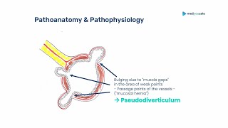 Diverticular Disease Diverticulitis  Introduction  Abdominal painAcute abdomen [upl. by Bendicta]