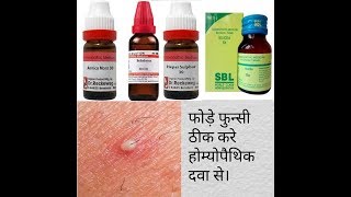 Boils homoeopathic medicine फोड़ों और फुंसी दूर करे by carewell homoeopathy [upl. by Adlee206]