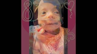 Katierae Trisomy 18 Awareness [upl. by Ahsienal]