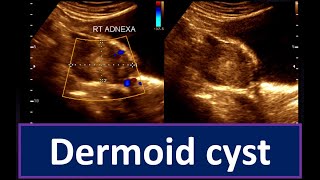 Understanding Dermoid Cyst  Guide to Ultrasonogram Diagnosis Ovarian Cyst  Practical Ultrasonogram [upl. by Korb]