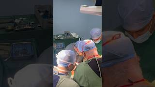 Hepatectomy I Advanced GI SURGERY I Liver Team I Surat I India [upl. by Bradshaw]