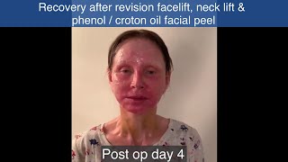 My Video Diary Part 1  Revision facelift necklift amp facial phenol  croton oil peel  First week [upl. by Africah]