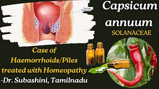 Case of Haemorrhoids Treated with Capsicum annuum I Homeopathy I DR SUBASHINI TAMILNADU [upl. by Saile974]