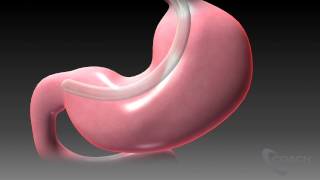 Sleeve Gastrectomy [upl. by Gnuhn]