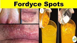 How to get ride Fordyce Spots  Treatments with natural Home Remedies 2018 [upl. by Goodwin209]