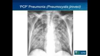 Opportunistic Infections I [upl. by Rudolph]