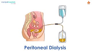 What is Peritoneal dialysis l Manipal Hospitals Bengaluru [upl. by Dalury]