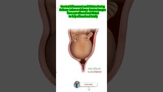 Cervical Effacement and Dilation During Delivery Labor or delivery baby shortvideo shot [upl. by Kimberlee]