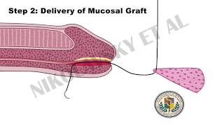 Minimally Invasive Method for Distal Urethral Reconstruction Patient Information [upl. by Ibot]