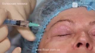 Правильная техника введения Dermaheal Eyebag Solution  FloSal [upl. by Ytomit]