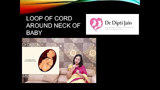 Cord around neck of baby  Nuchal Cord  Is it serious [upl. by Anelad729]