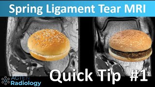 Quick tip 1 Spring Ligament Tear SHORTS [upl. by Vidovic]