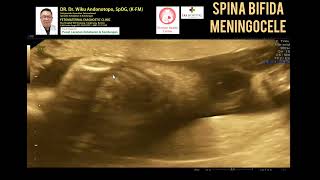 Spina Bifida Meningocele [upl. by Larrad]