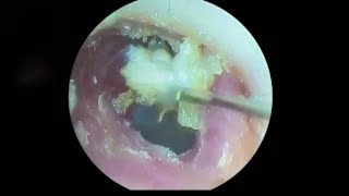 Ear wax removingsatisfying video for ear Fungus cleaning [upl. by Liv]