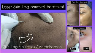 Skin Tag Removal Mole Removal  Wart Acrochordon Plasma Pen treatment  Medic clinic near LPU [upl. by Sadoc981]