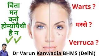 5 Best Homeopathy Medicines for Warts  Verruca  मस्से [upl. by Aldridge]