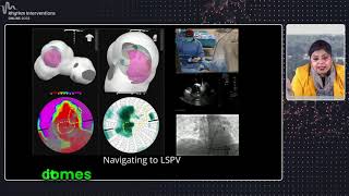 Globe Pulsed Field Mapping and Ablation System [upl. by Shaya250]