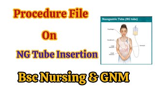 NG Tube Insertion ProcedureProcedure On NGTube Insertion proceduredemonstration nursing [upl. by Emalee666]