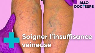 Jambes lourdes varices il existe des solutions  Allo Docteurs [upl. by Ahsenak]