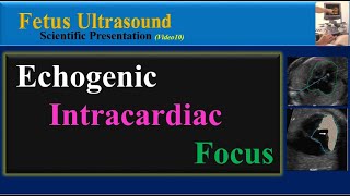 Fetus Ultrasound Echogenic Intracardiac Focus [upl. by Retsbew890]