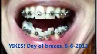 Full Braces Journey Time Lapse  3 Years Gaps Overbite Frenectomy  Starring Shameka [upl. by Erdnaxela990]