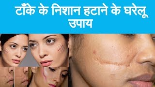 How to remove stitches marks in home remedy टाँके के निशान हटाने के घरेलू उपाय [upl. by Ohcamac755]