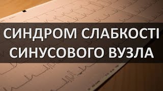 СИНДРОМ СЛАБКОСТІ СИНУСОВОГО ВУЗЛА ЕКГ ОЗНАКИ [upl. by Bible]