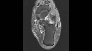 Posterior tibial tendon tear spring ligament tear and sinus tarsi inflammation [upl. by Matland26]