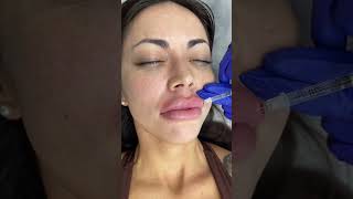 Lips Filler Treatment by our Cathy  Ageless MD [upl. by Shel]