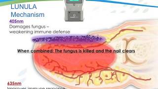 Toenail Fungus Treatment using PinPointe Laser  Laser Nail Therapy [upl. by Pyne979]