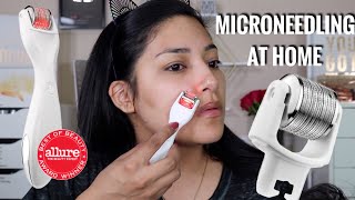 MICRONEEDLING MY FACE AT HOME  LEX TALK SKIN  ALEXISJAYDA [upl. by Aitan]