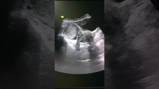 Right ovary dermoid cyst  Dermoid cyst imaging study ultrasound ovary scan shorts video [upl. by Matthias]