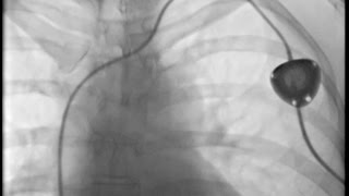 Interventional Radiology  Portacath Device Insertion [upl. by Meryl]