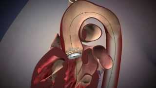 TAVR Edwards Sapien Aortic Valve Deployment [upl. by Shirberg415]