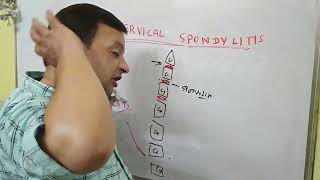 Cervical spondylitis  neck pain back pain cervicalpain  treatment of spondylitis [upl. by Nairrod]