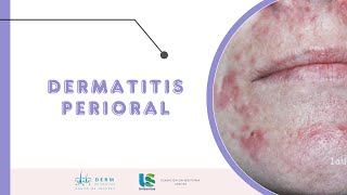 Dermatitis perioral [upl. by Wamsley]