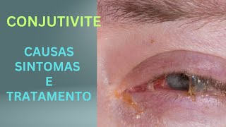 CONJUNTIVITE CAUSAS E SINTOMAS CAUSAS SINTOMAS E TRATAMENTO [upl. by Artemahs636]