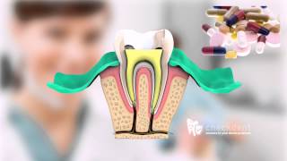 Why do Root Canals Hurt SO MUCH Live Root Canal Procedure [upl. by Ahsote]