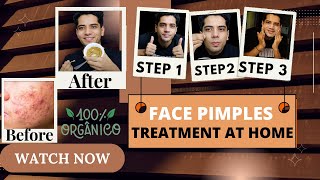 Face Pimples Treatment At Home  ACNE TREATMENT  Pimples Kese Hataye  shivammalik [upl. by Kinemod]