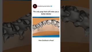 How Scoliosis is fixed scoliosis scoliosistreatment 3danimation shortsfeed animation shorts [upl. by Oyek]