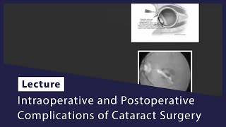 Intraoperative and Postoperative Complications of Cataract Surgery [upl. by Ateloj]