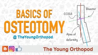 Basics of Osteotomy [upl. by Abner]