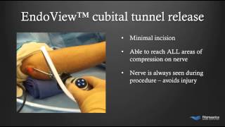 EndoTech® Endoscopic Cubital Tunnel Treatment  Fitzmaurice Hand Institute  Phoenix Arizona [upl. by Leahsim]