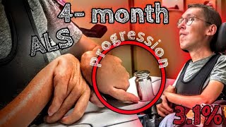 4Month ALS Progression  Lou Gehrigs Disease [upl. by Elfrieda]