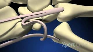 Rizartrosis tenosuspensiónTendon interposition arthroplasty [upl. by Ami]