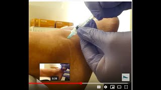 Video  sinus tarsi injection [upl. by Portland35]