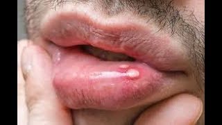 Early Signs of HIV in Men What Symptoms Should You Look out For [upl. by Leugimsiul]