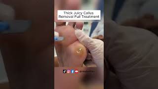 Ultimate Callus Removal Full Treatment For Smooth Feet  FootClinicLondoncouk [upl. by Ahel]